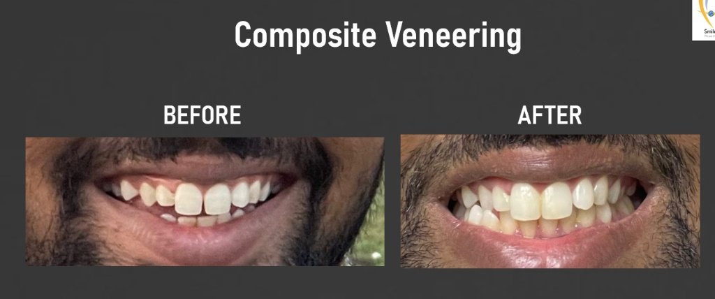 Composite Veneering Transformation